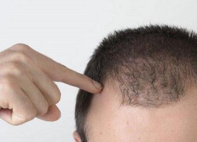 درباره بیوتین؛ ویتامینی موثر در رشد موی مردان